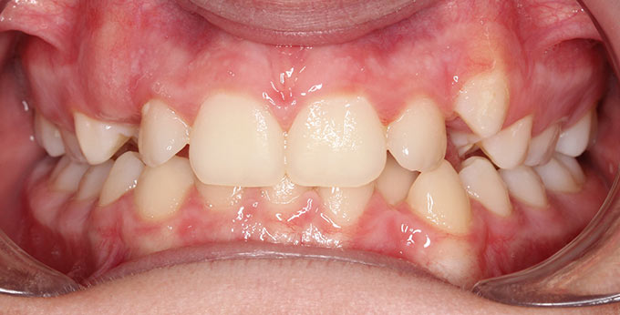 Male teeth before treatment for dental crowding and misalignment before treatment adult braces required 